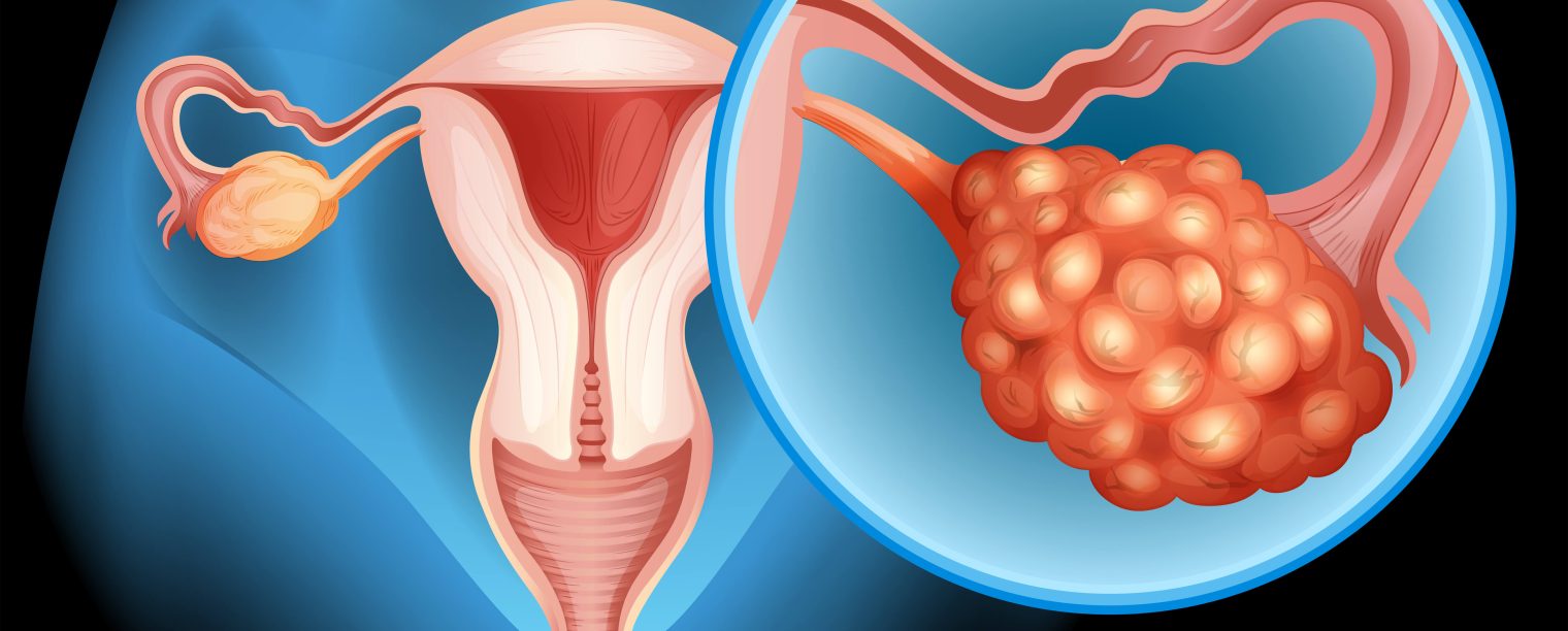 What to Expect From an Ovarian Cyst Treatment?