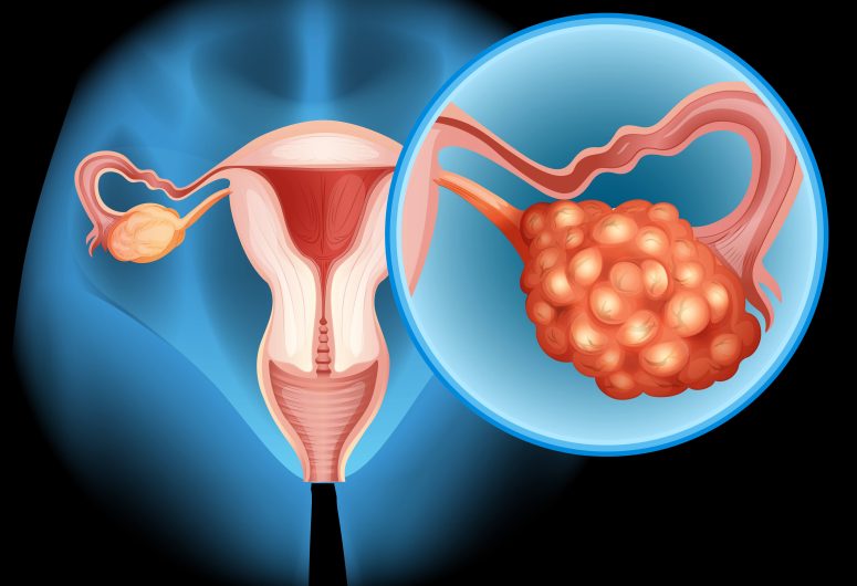 What to Expect From an Ovarian Cyst Treatment?
